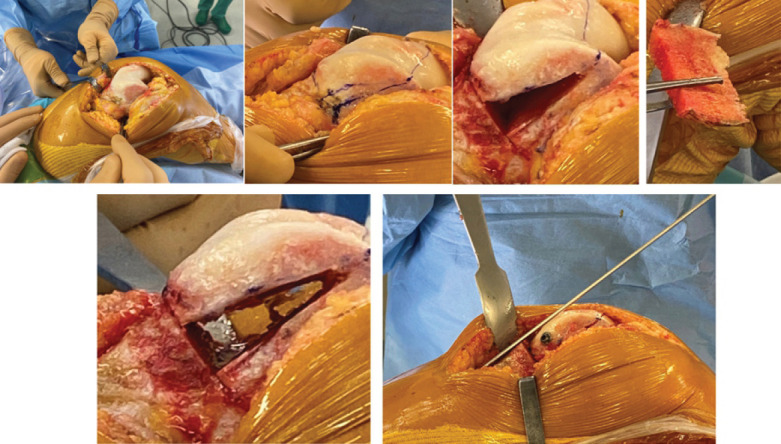 Chronic Flexion Patellar Dislocation with Femoral Patellofemoral Dysplasia and Anterior Bump: Treated by Distal Femoral Subtraction Osteotomy and Medial Patellofemoral Ligament Reconstruction - A Case Report.