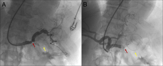 Lumen-Apposing Metal Stent Bleeding Risk: Management of Splenic Artery Erosion.