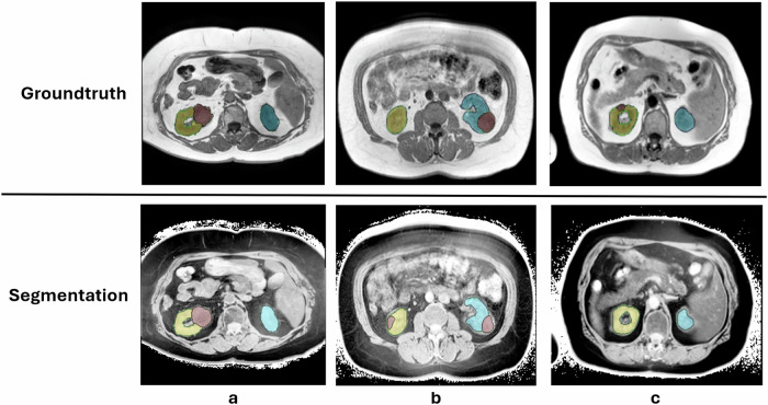 MRI annotation using an inversion-based preprocessing for CT model adaptation.