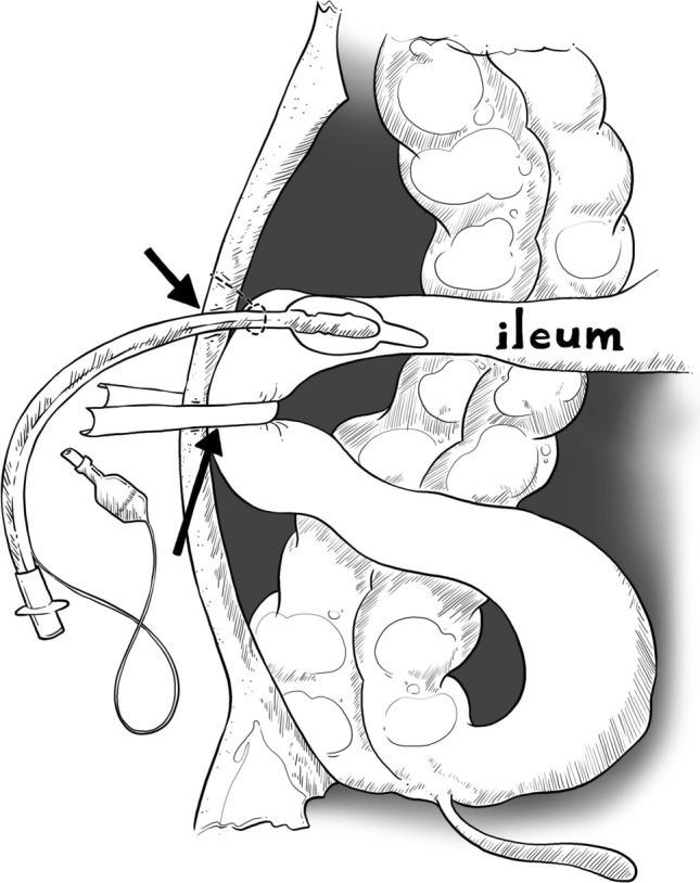 Comparing Wafi ileostomy to Brooke ileostomy in stage 3 rectal cancer: a prospective cohort study.