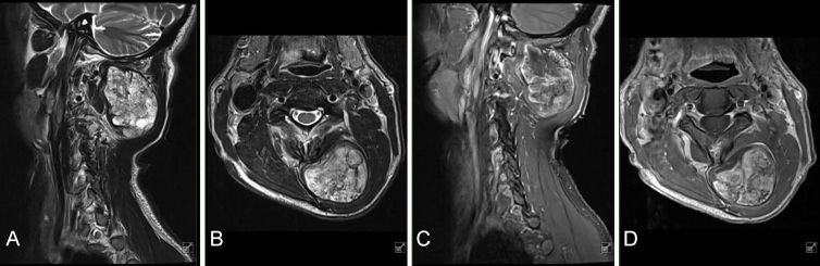 Extraskeletal para-articular osteochondroma adjacent to the cervical spine: illustrative case.