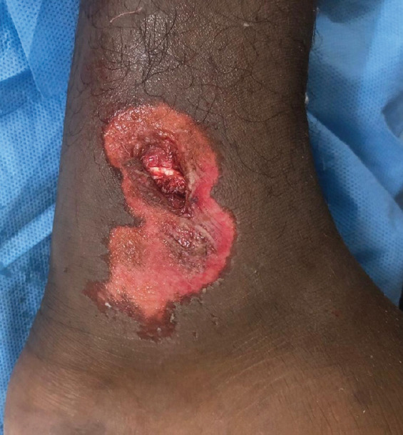 A Rare Case of Talus Neck and Open Medial Malleolus Fractures with Ankle Subluxation Treated using a Single Anteromedial Approach.