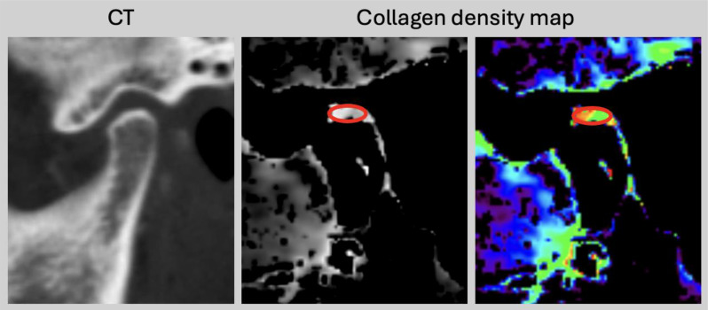 Dual-energy computed tomography collagen density mapping of the temporomandibular disc.