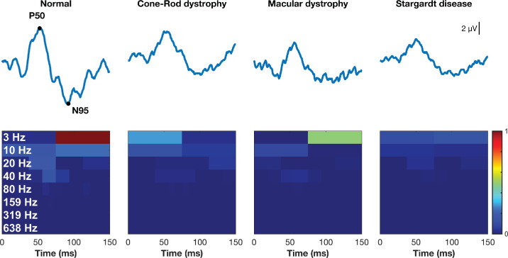 Multidimensional Quantification of Macular Cone Activity in Pattern Electroretinography Using Discrete Wavelet Transform.