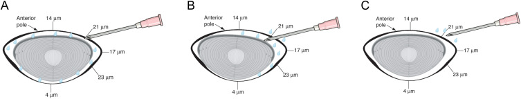 Evaluation of a Modified Single-Stage Continuous Curvilinear Capsulorhexis Technique Using 18-Gauge Needle Decompression in Intumescent Cataracts.