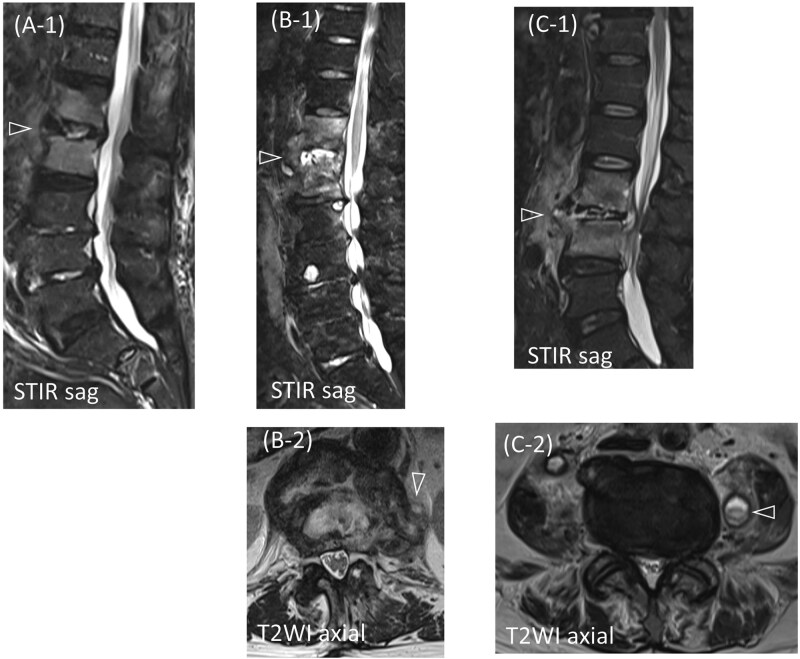 Successful treatment of pyogenic spondylitis in a non-ankylosing lesion of diffuse idiopathic skeletal hyperostosis using penetrating endplate screws: a three-case report.