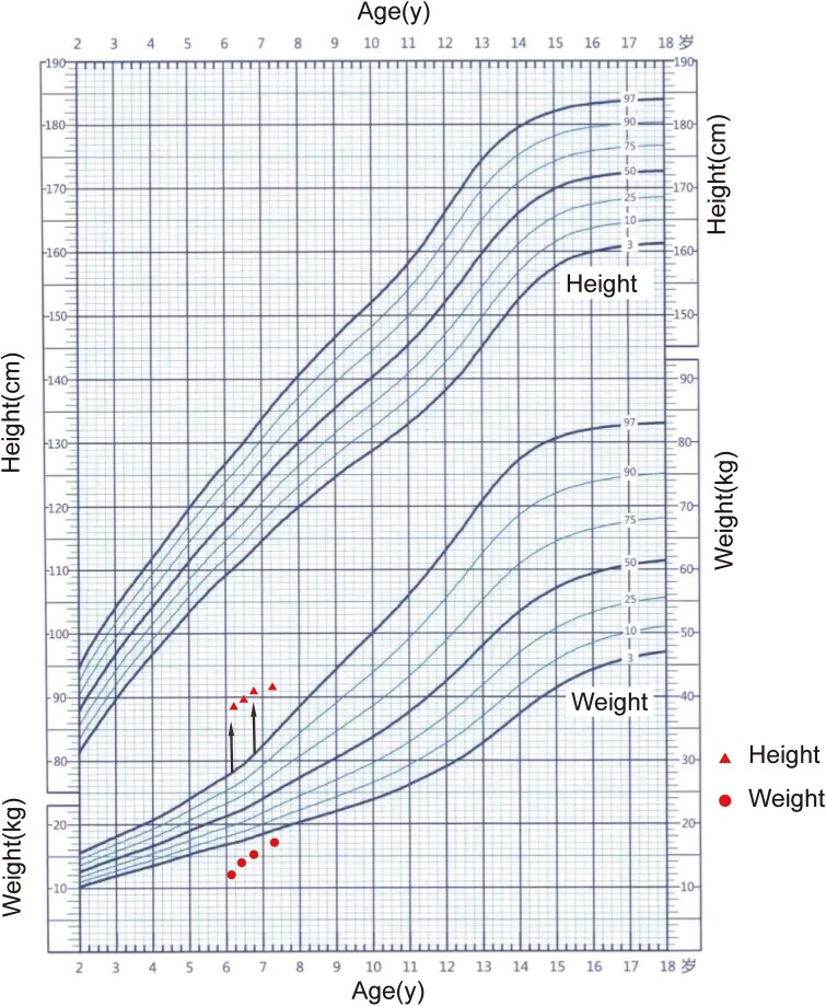 A case report of SPONASTRIME dysplasia with novel TONSL mutation: genetic analysis, clinical manifestations, and the effect of growth hormone treatment.
