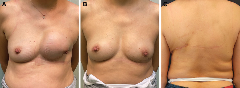 The Versatility of the Fat-extended, Muscle-sparing Latissimus Dorsi Flap in Breast Reconstruction.