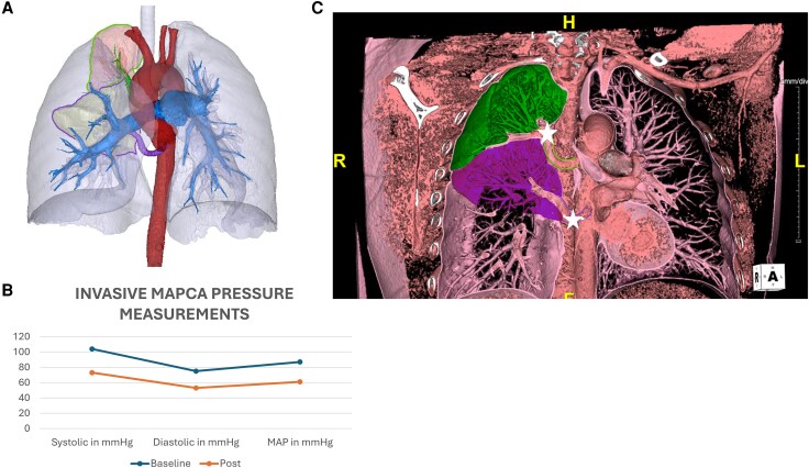 Case report of transcatheter flow restriction in isolated non-redundant major aorto-pulmonary collateral arteries.
