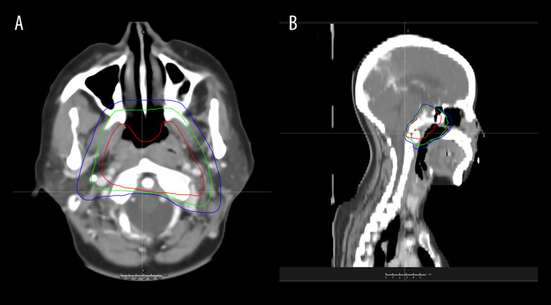 Nasopharyngeal Giant Carcinoma Mimicking Intracranial Lesions: A Case Report and Literature Review.