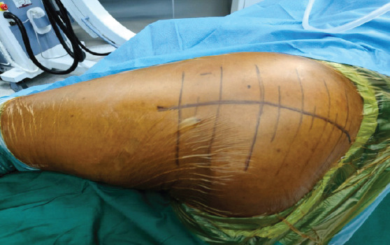 Extraarticular Interfragmentary Fixation of an Irreducible Pipkin Type 1 Fracture Dislocation of the Hip - A Case Report.