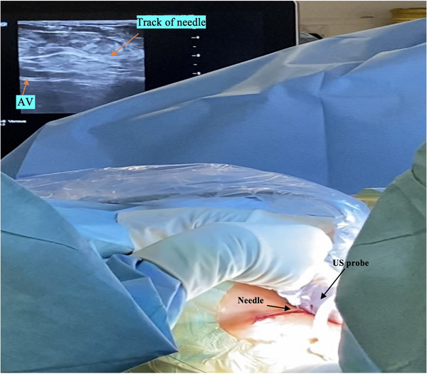 Ultrasound Guided Venous Access for Cardiac Devices: Defining Learning Curve for Safety, Efficacy, and Radiation Exposure.