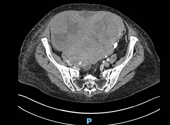 Bilateral pleural effusions, ascites and pulmonary emboli: Meigs syndrome.