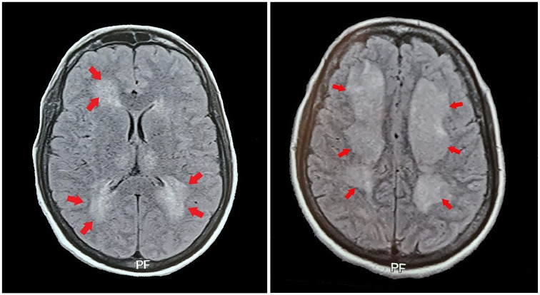 Beyond the Usual Features-Expanded Dengue Syndrome in Association With Possible Pre-existing Neurological Disease: A Case Report.