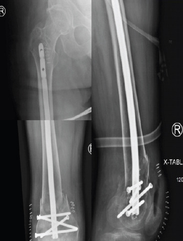 Treatment of Bilateral Distal Femoral Shaft Fractures in a Paraplegic Patient with Intramedullary Nailing: A Case Report.