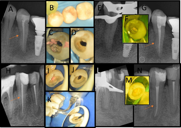 Postoperative Pain Following Single-Visit Nonsurgical Retreatment Using Minimally Invasive Rotary vs. Reciprocating Nickel-Titanium File Systems: A Two-Arm Parallel Randomized Clinical Trial.