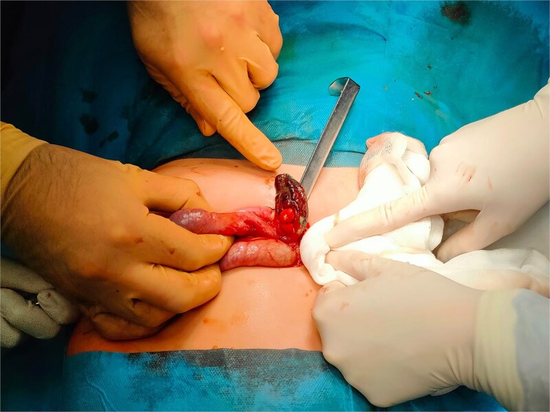 When appendicitis mimics a liver abscess: diagnostic challenges in pediatric surgery.