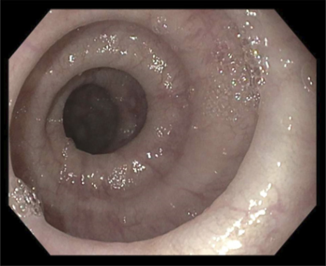 Where the Jackhammer Meets the Corkscrew: A Case of Manometric Hypercontractile Esophagus and Esophagogastric Junction Outflow Obstruction With Endoscopic Features of Distal Esophageal Spasm.