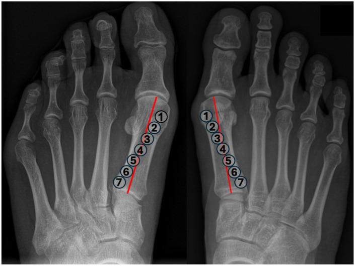 Metatarsal Pronation on Radiographs: A Prospective Reliability Study of Visual Rotation Markers in Hallux Valgus.