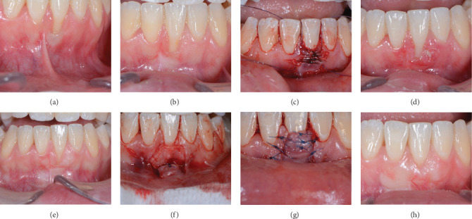 Retreatment of Gingival Recessions: Rationale and Definition Case Series Follow-Up.