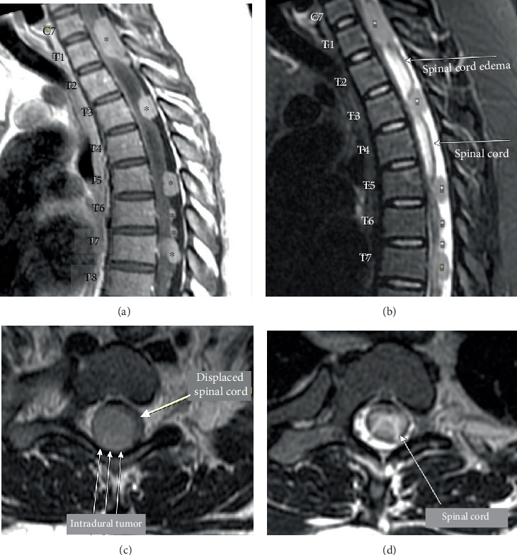 A Rare Presentation of Adult Primary Leptomeningeal Medulloblastoma: Case Report.