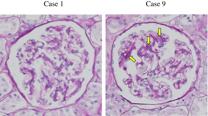 Glomerular Galactose-Deficient IgA1 Deposition in 192 Autopsy Cases in Japan.