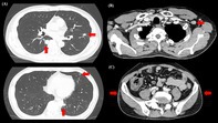 Asymptomatic Neurosyphilis Presenting With Bilateral Pulmonary Nodules: A Case Report.