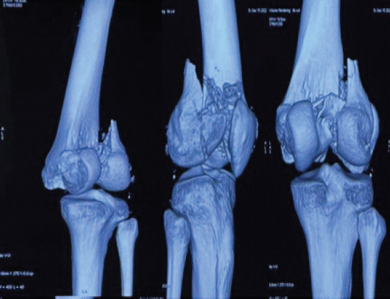 Isolated Double Hoffa Fracture of the Distal Femur without Intercondylar Extension: A Rare Case Report.