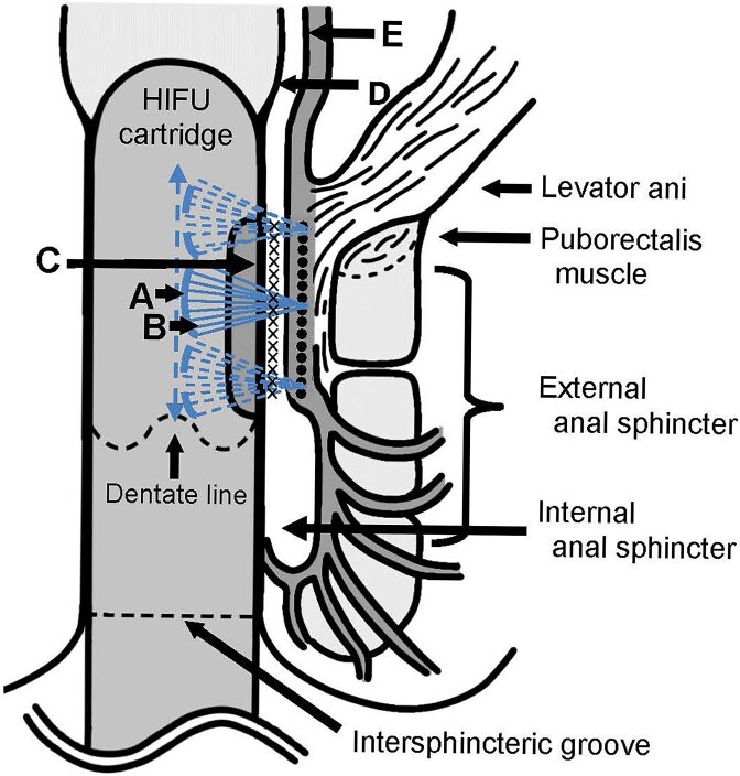High-intensity focused ultrasound rectoanal lifting (HIFU-RAL) for prolapsed hemorrhoids: a case series.
