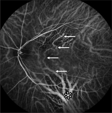 Central serous chorioretinopathy imaging biomarkers as potential indicators of response to subthreshold nanosecond laser.
