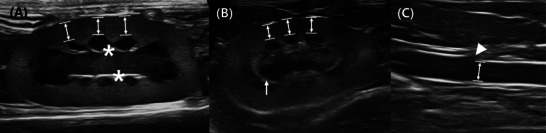 Feline Renal Cortical Thickness-Aortic Diameter Ratio in Healthy Versus Diseased Kidneys: Comparative Ultrasonographic Evaluation.