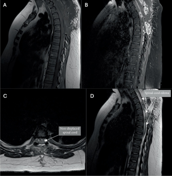 A Rare Presentation of Adult Primary Leptomeningeal Medulloblastoma: Case Report.