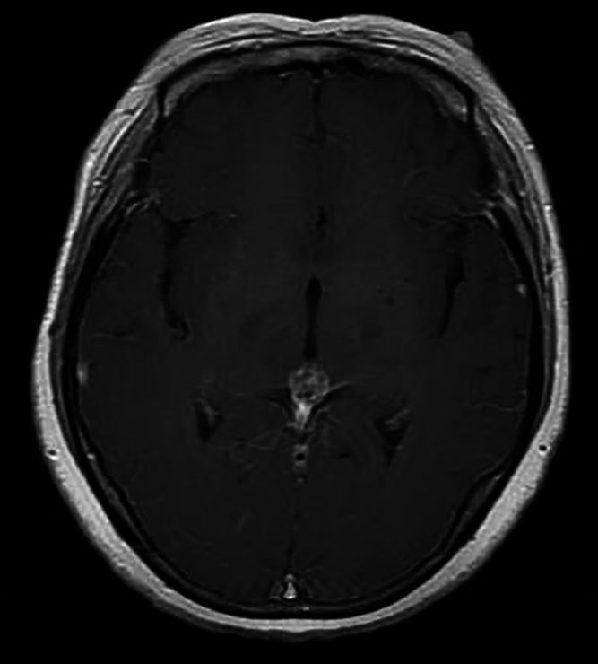 Primary malignant melanoma of the pineal region: illustrative case.