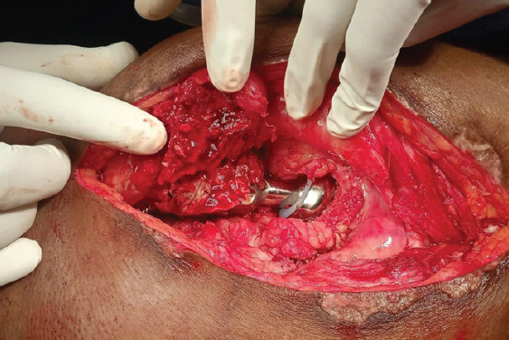 The Price of Poor Cementing: A Case Report on Chronic Hip Dislocation and Revision.