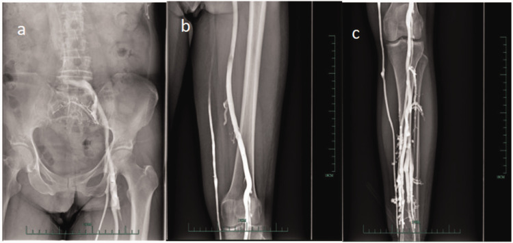 Multiple injections of indocyanine green for improving the outcomes of lymphatic-venous anastomosis reconstruction of lymphatic return under microscopy: A case report.