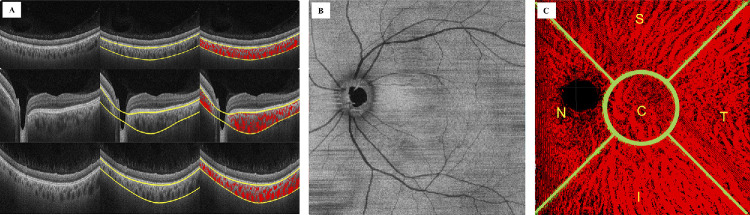 Three-Dimensional Choroidal Vessels Assessment in Fellow Eyes of Patients With Central Serous Chorioretinopathy.