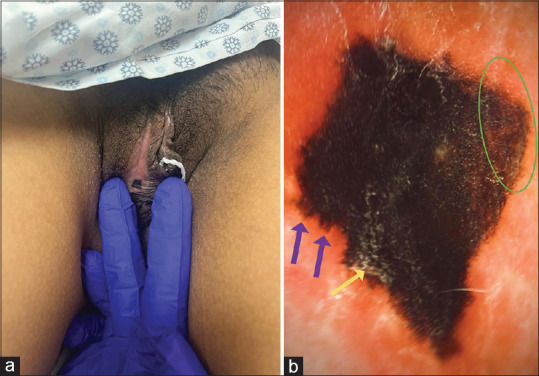 Dermoscopic Features of Vulvar Melanoma.