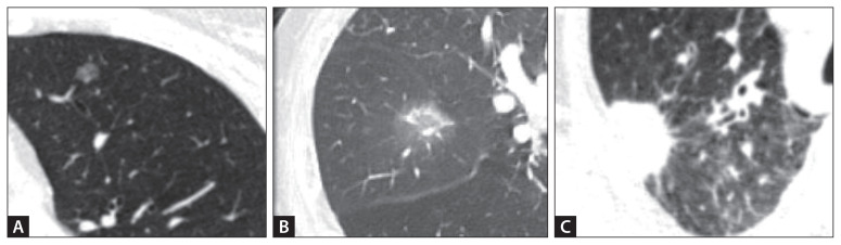 Diagnostic approach for incidental pulmonary nodules.