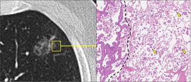 There Is More Than Meets the Eye With Ground Glass Nodules: Is It Too Early to Adopt Sublobar Resection as Standard of Care for Early Stage Lung Adenocarcinoma?