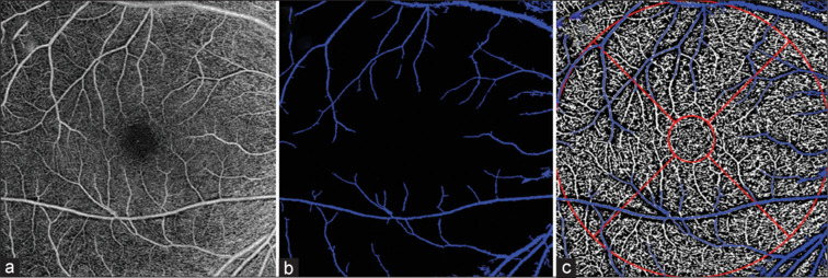 Effect of nasal and temporal scanning tilt on whole and local macular vessel density measurement using OCTA.