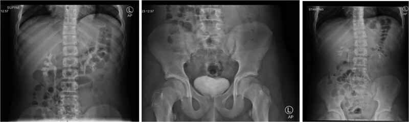 Castleman disease: a case report of a pediatric incidental case in Saudi Arabia.