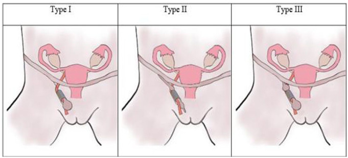 Hydrocele of the Canal of Nuck: A Rare Etiology of Inguino-Labial Swelling in a Young Female: A Case Report.