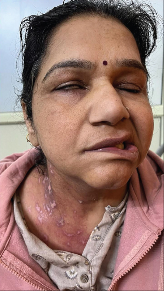 Bell's Palsy following Cervical Herpes Zoster.