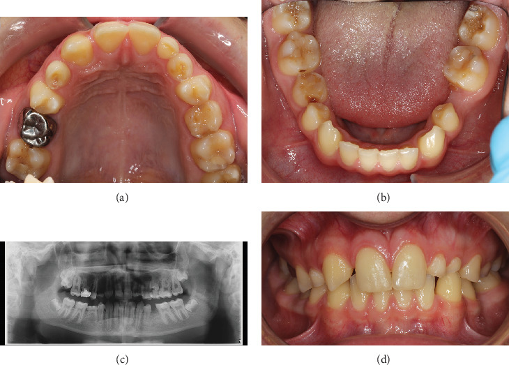 Combining a Sinus Augmentation With Tooth Transplantation When Replacing a Missing Premolar in a Young Patient.