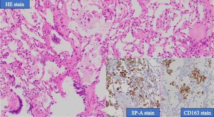 The Paradox of Metachronous Lipoid Pneumonia.