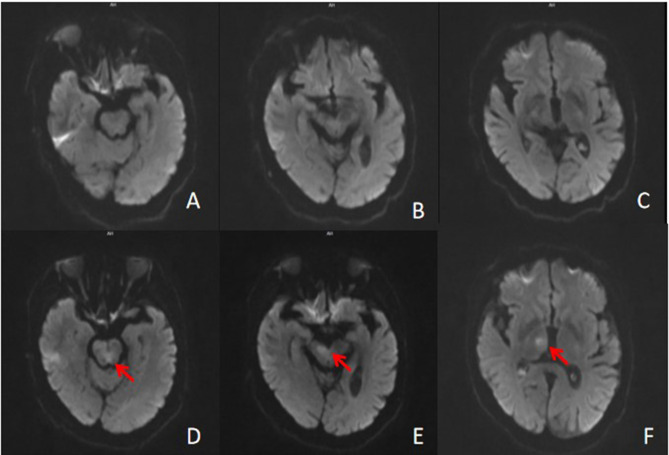 Bilateral Oculomotor Nerve Palsy: A Rare Complication of Bridging Thrombolysis for Acute Basilar Artery Occlusion.