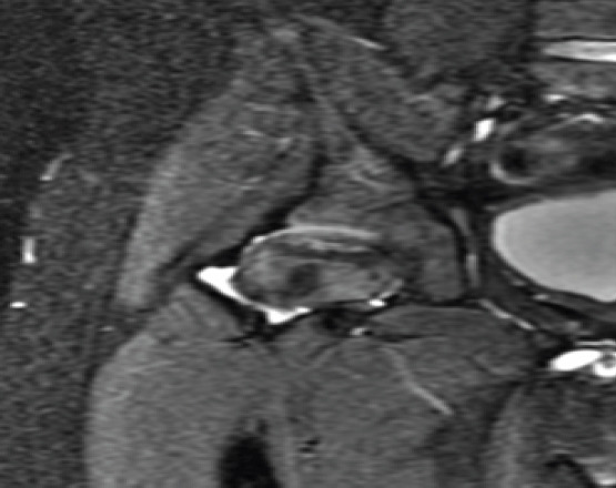 Developmental Hip Dysplasia Presenting as Bilateral Osteochondritis Dissecans Perthes-like Lesions Treated with Triple Pelvic Osteotomies: A Case Report.