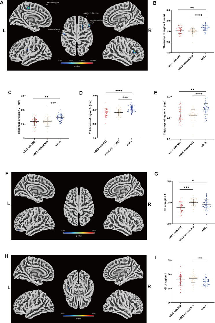 Cortical changes in women with systemic lupus erythematosus with mild cognitive impairment: a voxel-based morphometry and surface-based morphometry study.