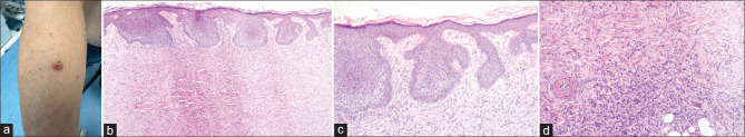 Collision Tumor of Dermatofibroma and Basal Cell Carcinoma: Clinical Insights and Diagnostic Challenges.