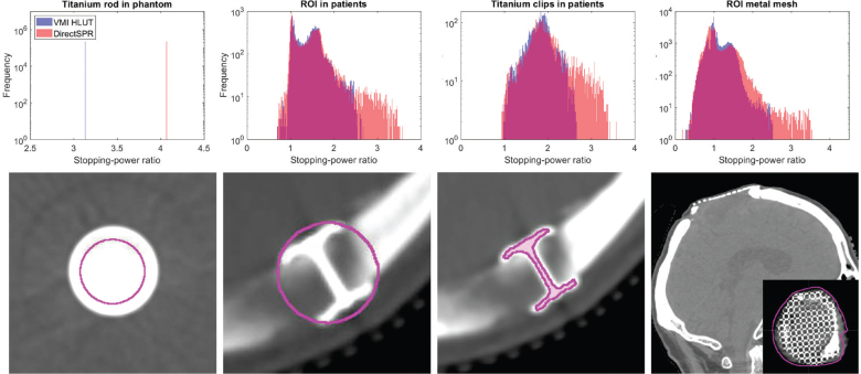 Comparison of two dual-energy CT-based methods for proton stopping-power ratio estimation in brain cancer patients with metal implants.